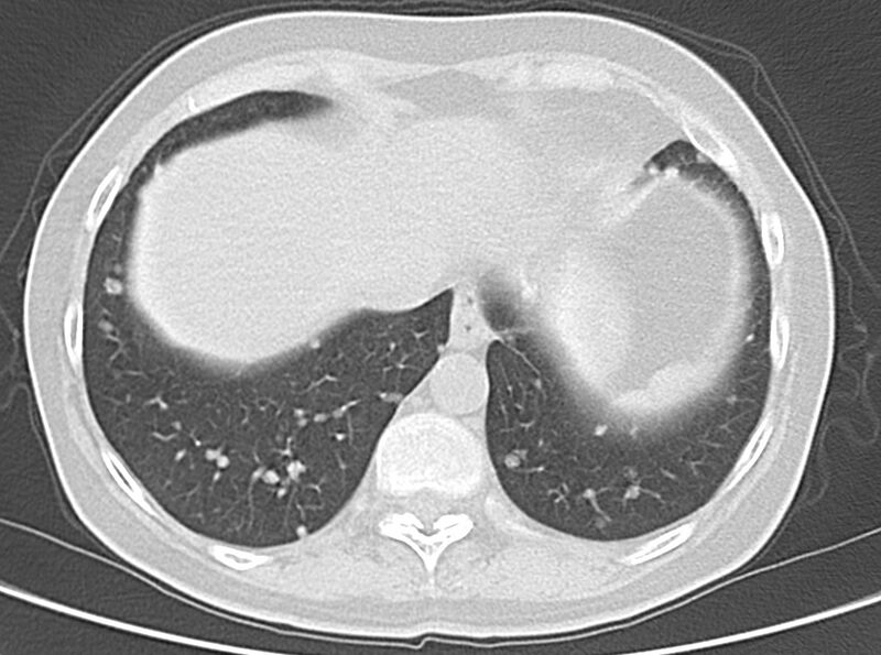 File:Adenosquamous lung carcinoma (Radiopaedia 22035-22030 lung window 49).jpg