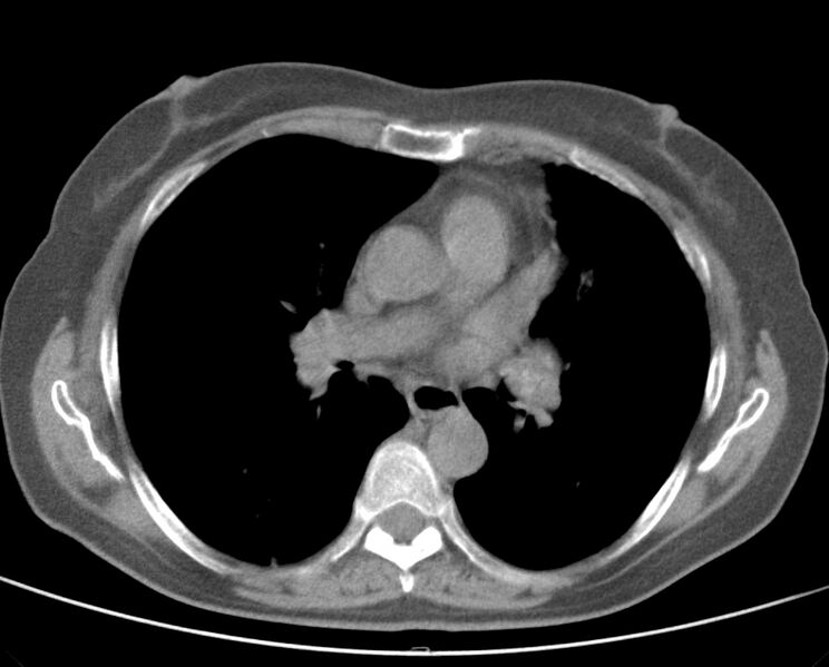 File:Adenosquamous lung carcinoma (Radiopaedia 22035-22030 non-contrast 32).jpg