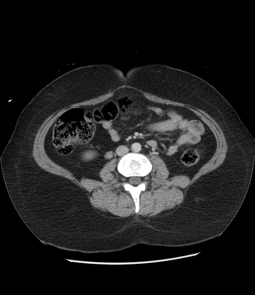 File:Adrenal cortical carcinoma with IVC invasion and thrombosis (Radiopaedia 34307-35597 Axial C+ portal venous phase 50).jpg