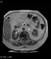 Adrenal myelolipoma (Radiopaedia 6765-7961 Axial T1 in-phase 25).jpg