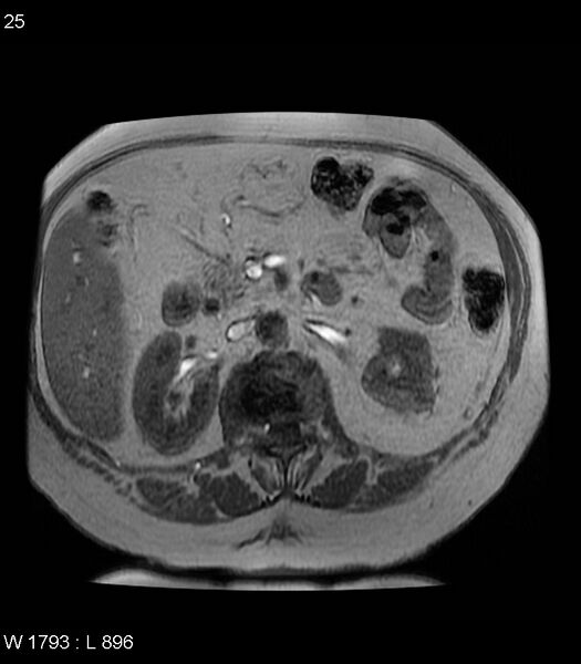 File:Adrenal myelolipoma (Radiopaedia 6765-7961 Axial T1 in-phase 25).jpg