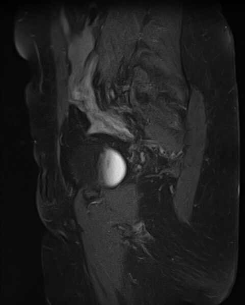 File:Adult granulosa cell tumor of the ovary (Radiopaedia 71581-81950 Sagittal T1 C+ fat sat 18).jpg