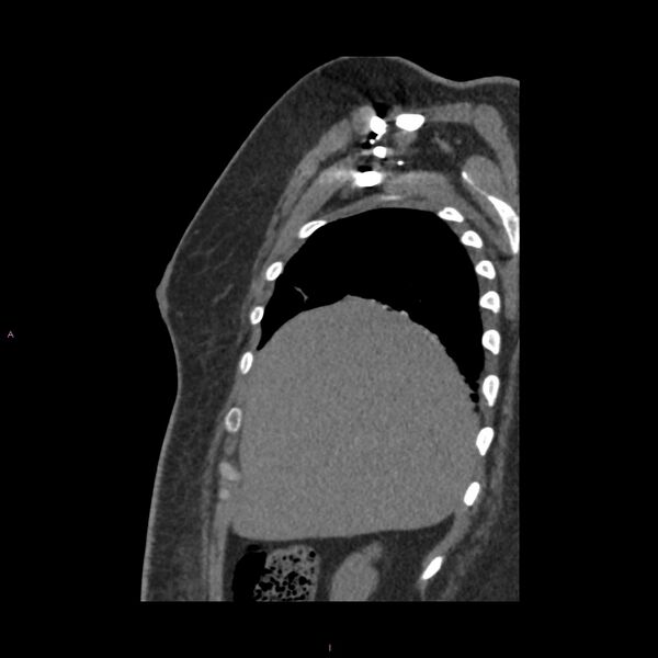 File:Agenesis of the left hepatic lobe (Radiopaedia 77284-89359 Sagittal C+ CTPA 17).jpg