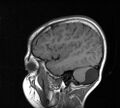 Aicardi syndrome (Radiopaedia 66029-75205 Sagittal T1 20).jpg