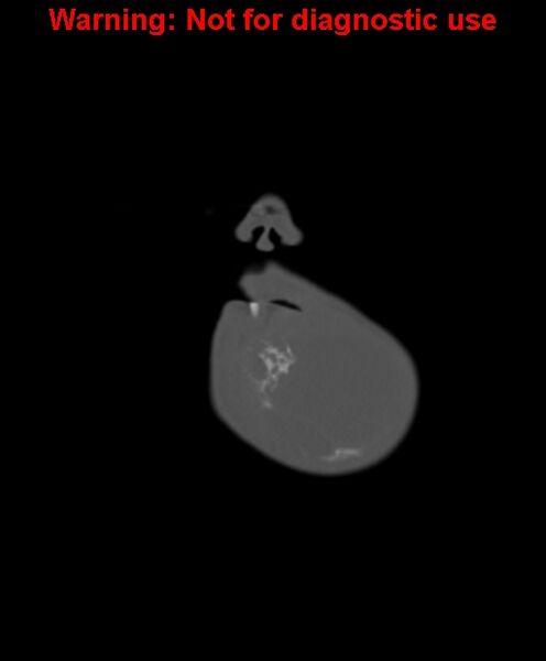 File:Ameloblastoma (Radiopaedia 33126-34164 Coronal bone window 4).jpg