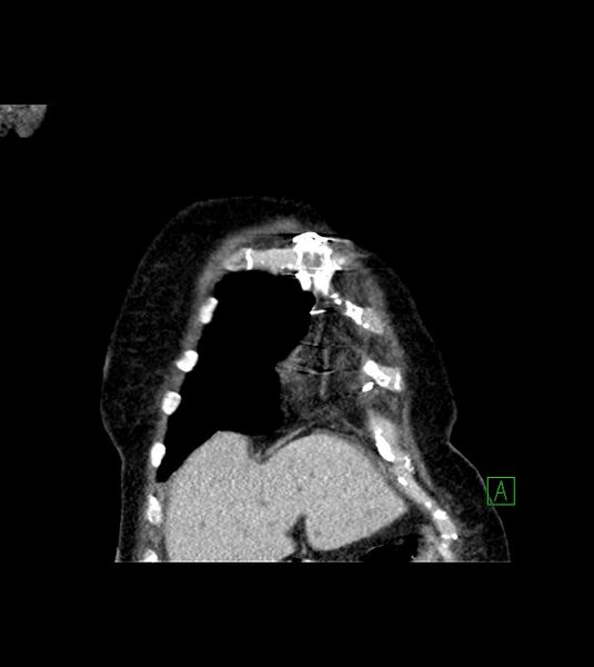 File:Amiodarone deposition in the liver (Radiopaedia 77587-89780 Coronal non-contrast 16).jpg