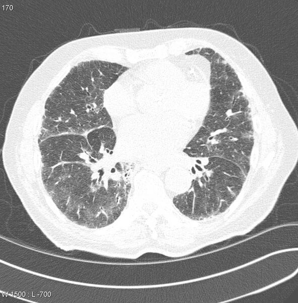 File:Amiodarone lung (Radiopaedia 6539-7851 Axial lung window 17).jpg