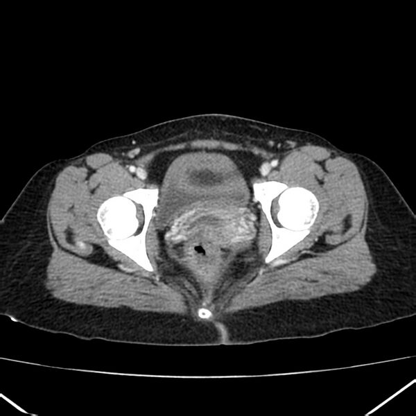 File:Ampullary tumor (Radiopaedia 22787-22816 C 66).jpg