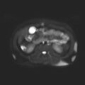 Ampullary tumor (Radiopaedia 27294-27479 T2 SPAIR 3).jpg
