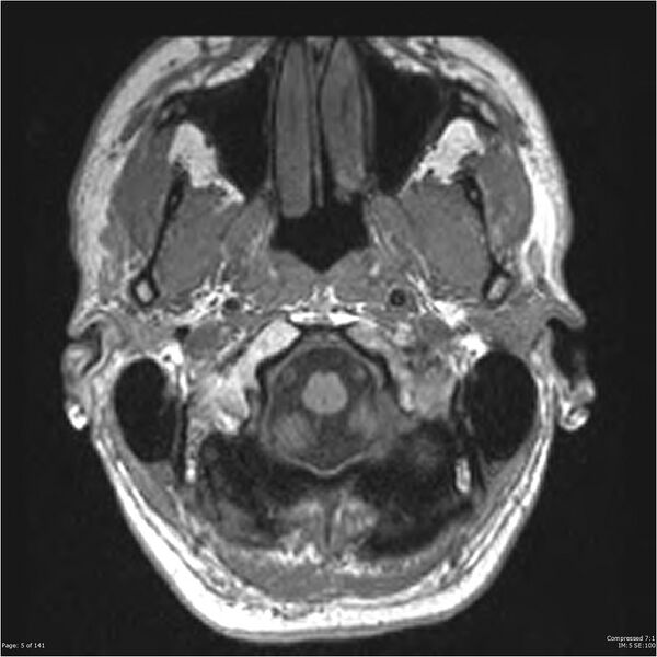 File:Anaplastic meningioma with recurrence (Radiopaedia 34452-35788 Axial T1 3).jpg