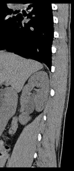File:Aneurysmal bone cyst T11 (Radiopaedia 29294-29721 E 71).jpg