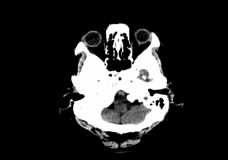 File:Anomalous intracranial venous drainage (Radiopaedia 28161-28418 Axial non-contrast 6).jpg