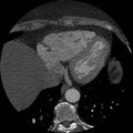 Anomalous origin of left circumflex artery from right coronary sinus (Radiopaedia 72563-83117 B 139).jpg