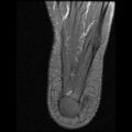 Anterior calcaneal process fracture (Radiopaedia 74654-85611 Axial PD fat sat 28).jpg