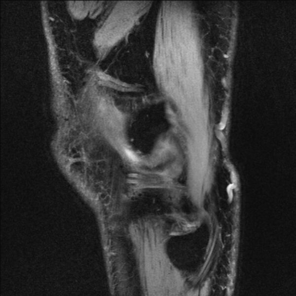 File:Anterior cruciate ligament mucoid degeneration (Radiopaedia 68400-77933 Sagittal 4).jpg