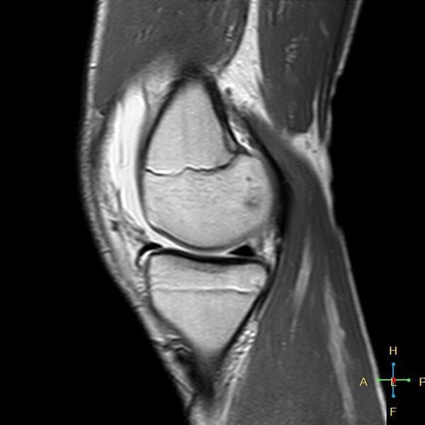 File:Anterior cruciate ligament tear - complete (Radiopaedia 24907-25170 Sagittal PD 13).jpg