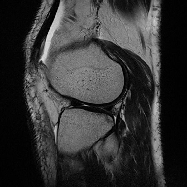 File:Anterior cruciate ligament tear - ramp lesion (Radiopaedia 71883-82322 Sagittal T2 7).jpg