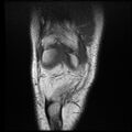 Anterior cruciate ligament tear with posteromedial corner injury, bucket-handle meniscal tear and chondral delamination (Radiopaedia 75501-86744 Coronal T1 6).jpg