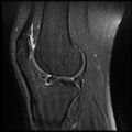 Anterior cruciate ligament tear with posteromedial corner injury, bucket-handle meniscal tear and chondral delamination (Radiopaedia 75501-86744 Sagittal PD fat sat 18).jpg