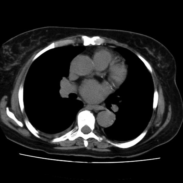 File:Aortic arch pseudoaneurysm (Radiopaedia 8534-9368 Axial non-contrast 39).jpg