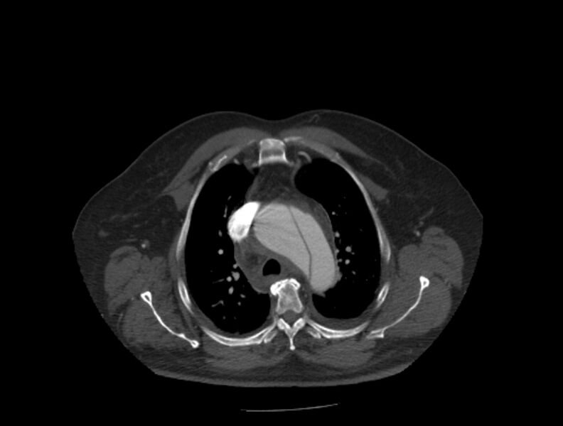 File:Aortic dissection (Radiopaedia 28802-29105 A 7).jpg