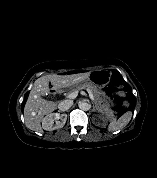 File:Aortic dissection with renal ischemia (Radiopaedia 76573-88338 B 29).jpg