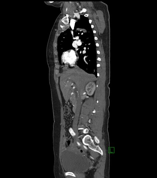File:Aortic dissection with renal ischemia (Radiopaedia 76573-88338 D 8).jpg