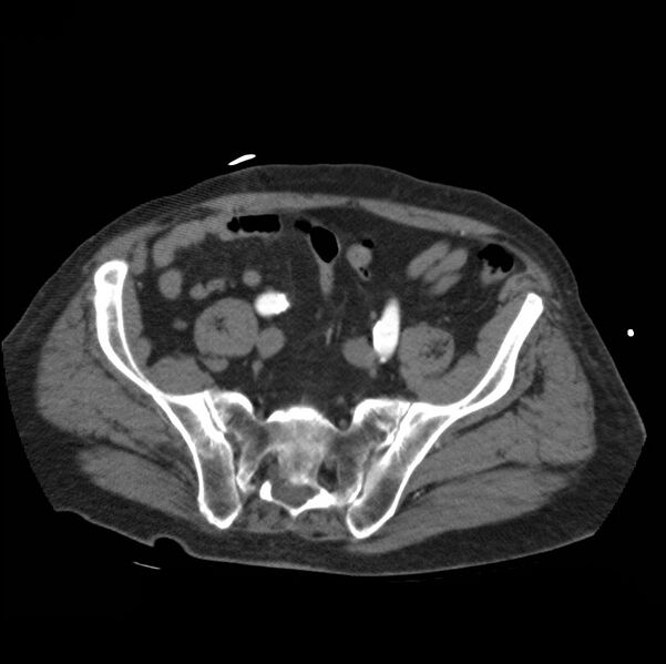 File:Aortic dissection with rupture into pericardium (Radiopaedia 12384-12647 A 77).jpg