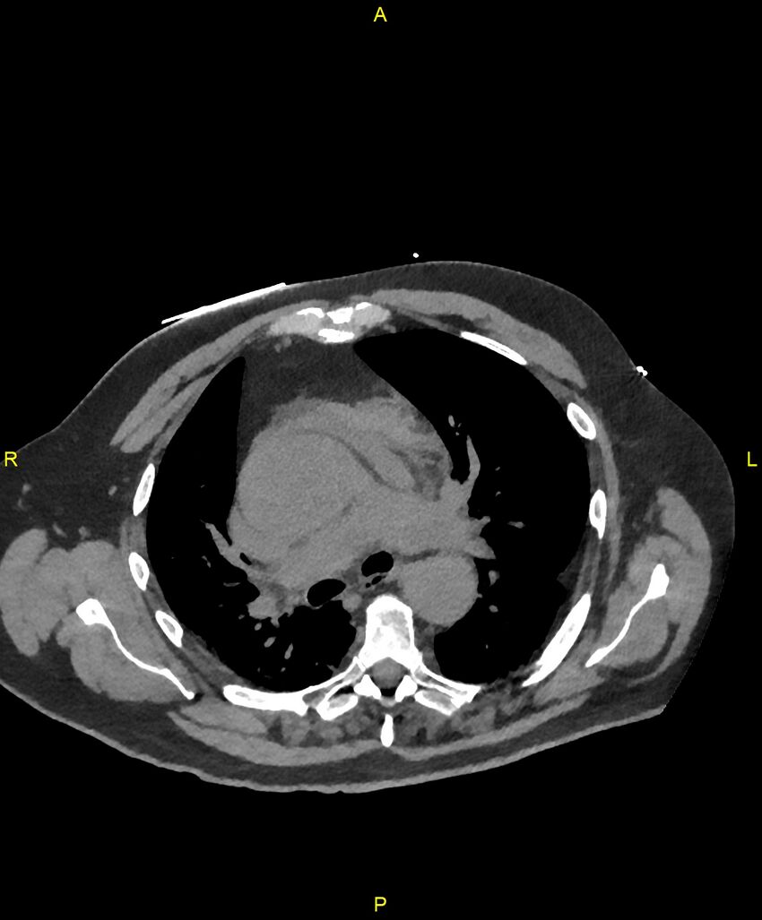 Aortic rupture (Radiopaedia 88822-105594 Axial non-contrast 82).jpg