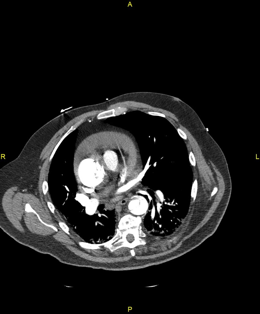 Aortic rupture (Radiopaedia 88822-105594 B 124).jpg