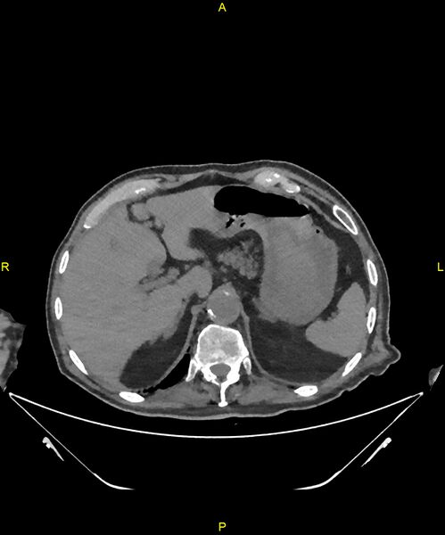 File:Aortoenteric fistula (Radiopaedia 84308-99603 Axial non-contrast 64).jpg