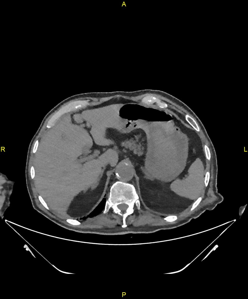 Aortoenteric fistula (Radiopaedia 84308-99603 Axial non-contrast 64).jpg