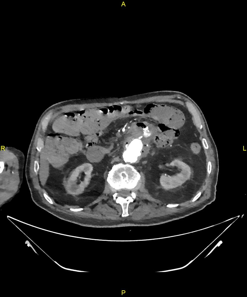 Aortoenteric fistula (Radiopaedia 84308-99603 B 129).jpg