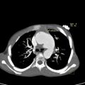 Aortopulmonary window, interrupted aortic arch and large PDA giving the descending aorta (Radiopaedia 35573-37077 Axial +C 1).jpg