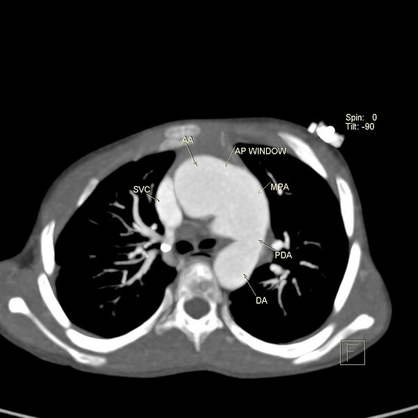 File:Aortopulmonary window, interrupted aortic arch and large PDA giving the descending aorta (Radiopaedia 35573-37077 Axial +C 1).jpg