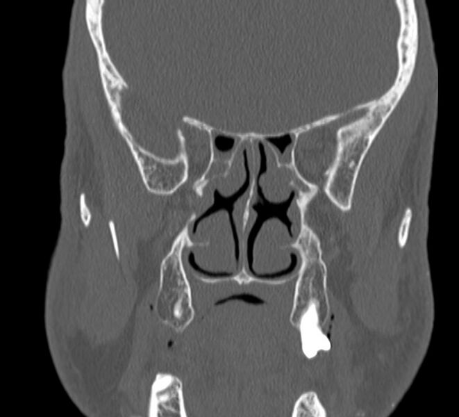 File:Aplastic maxillary sinuses (Radiopaedia 60030-67561 Coronal non-contrast 25).jpg