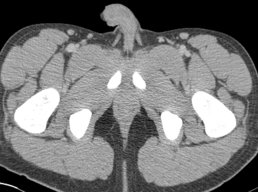 Appendicitis and incidental foregut duplication cyst (Radiopaedia 52962-58916 A 113).jpg