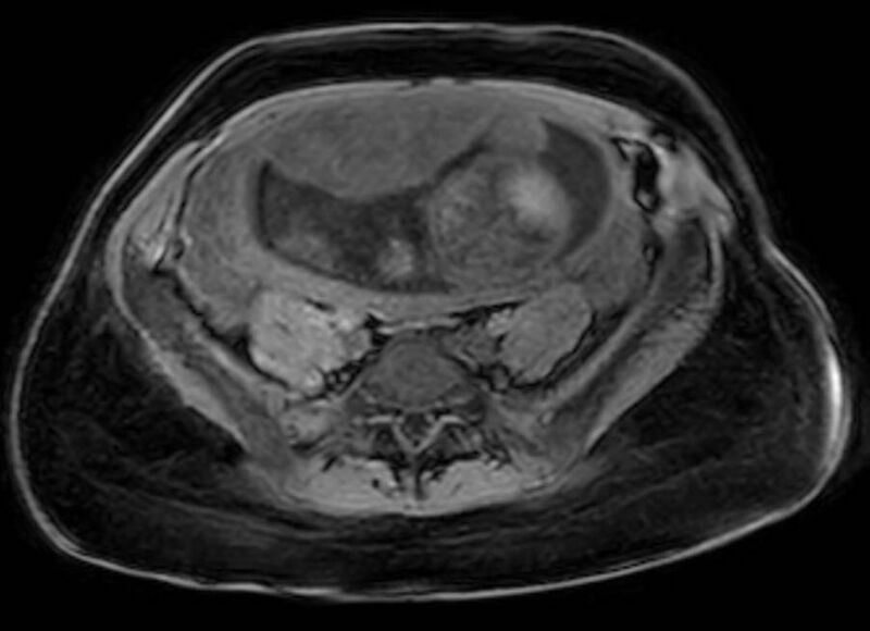 File:Appendicitis in gravida (MRI) (Radiopaedia 89433-106395 Axial DIXON 100).jpg