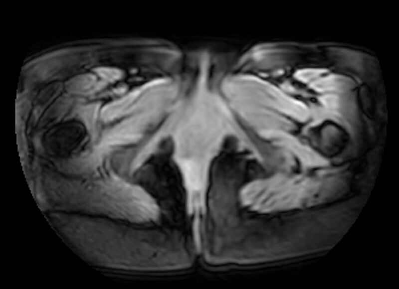 File:Appendicitis in gravida (MRI) (Radiopaedia 89433-106395 Axial DIXON 160).jpg