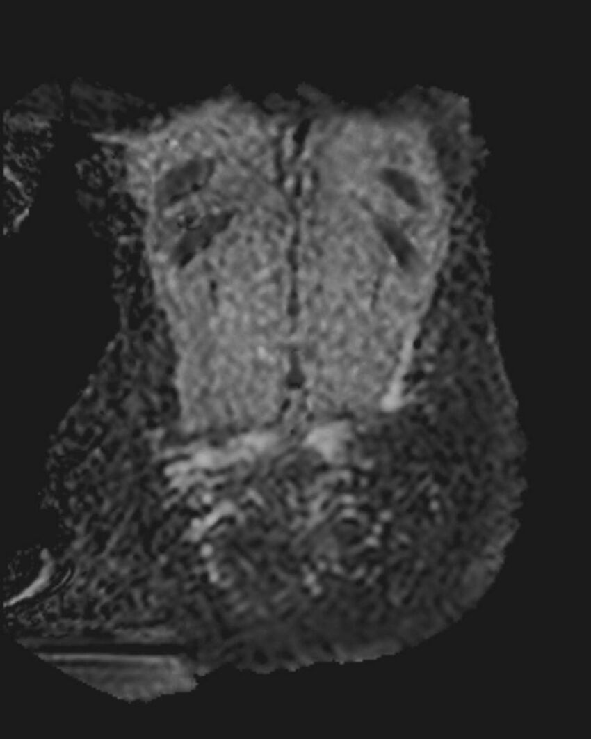 Appendicitis in gravida (MRI) (Radiopaedia 89433-106395 Coronal ADC 51).jpg