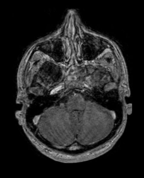 File:Arachnoid cyst- extremely large (Radiopaedia 68741-78451 Axial T1 C+ 20).jpg