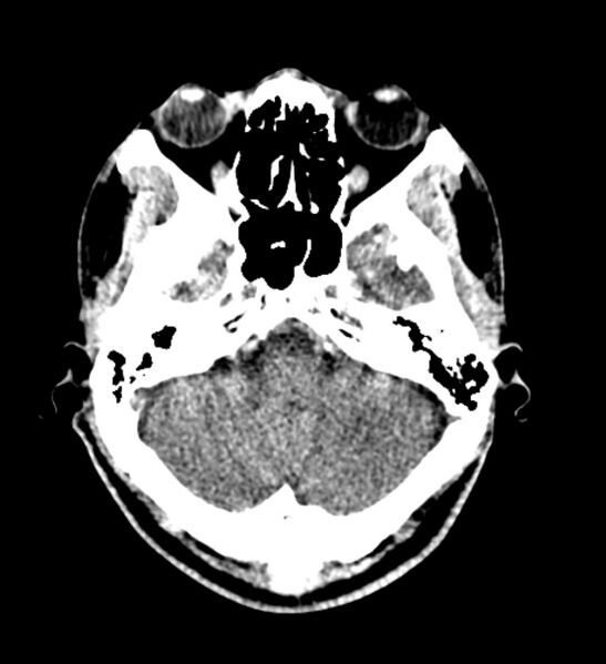 File:Arachnoid cyst of the ambient cistern (Radiopaedia 81301-94986 Axial non-contrast 15).jpg
