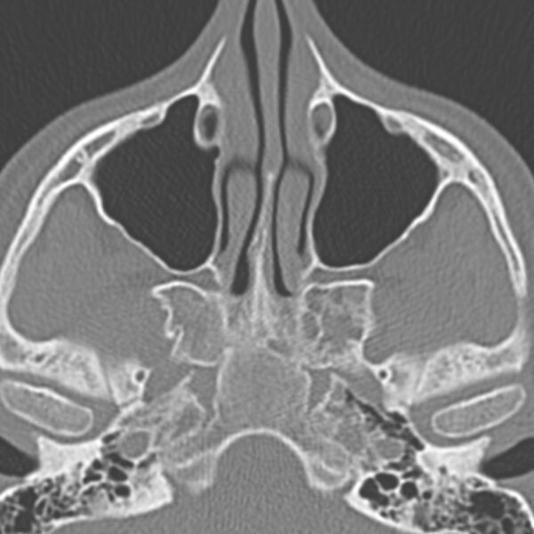 File:Arrested pneumatization of the sphenoid (Radiopaedia 10700-11172 Axial non-contrast 9).jpg