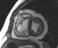 Arrhythmogenic right ventricular cardiomyopathy (Radiopaedia 69431-79307 Short axis cine 113).jpg