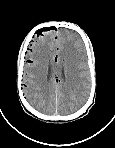 File:Arrow injury to the brain (Radiopaedia 72101-82607 Axial non-contrast 78).jpg