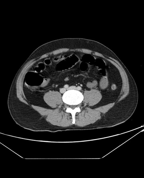 File:Arterial occlusive mesenteric ischemia (Radiopaedia 84641-100054 A 76).jpg