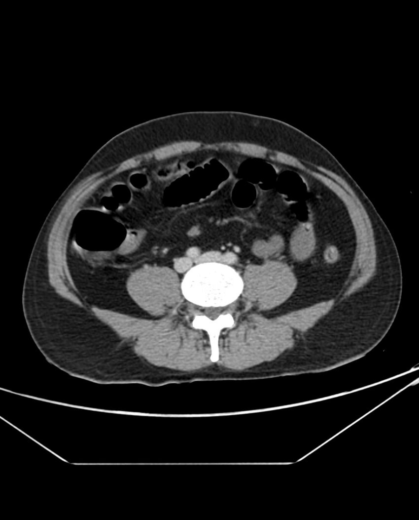 Arterial occlusive mesenteric ischemia (Radiopaedia 84641-100054 A 76).jpg