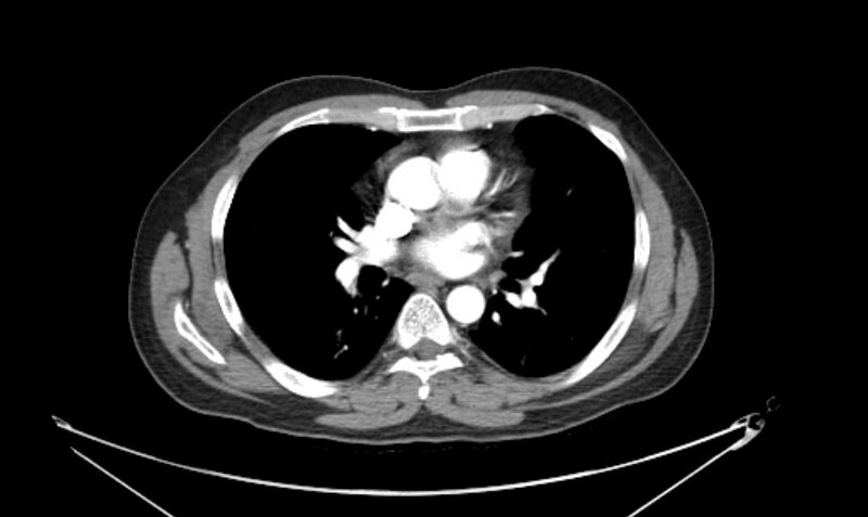 File:Arterial occlusive mesenteric ischemia (Radiopaedia 84641-100060 A 3).jpg