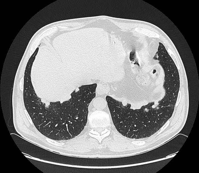 File:Asbestos pleural placques (Radiopaedia 57905-64872 Axial lung window 198).jpg