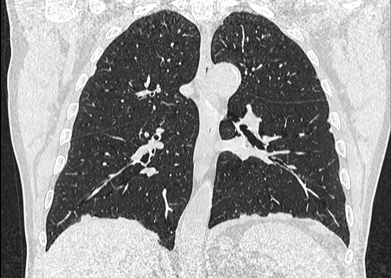 File:Asbestos pleural placques (Radiopaedia 57905-64872 Coronal lung window 175).jpg